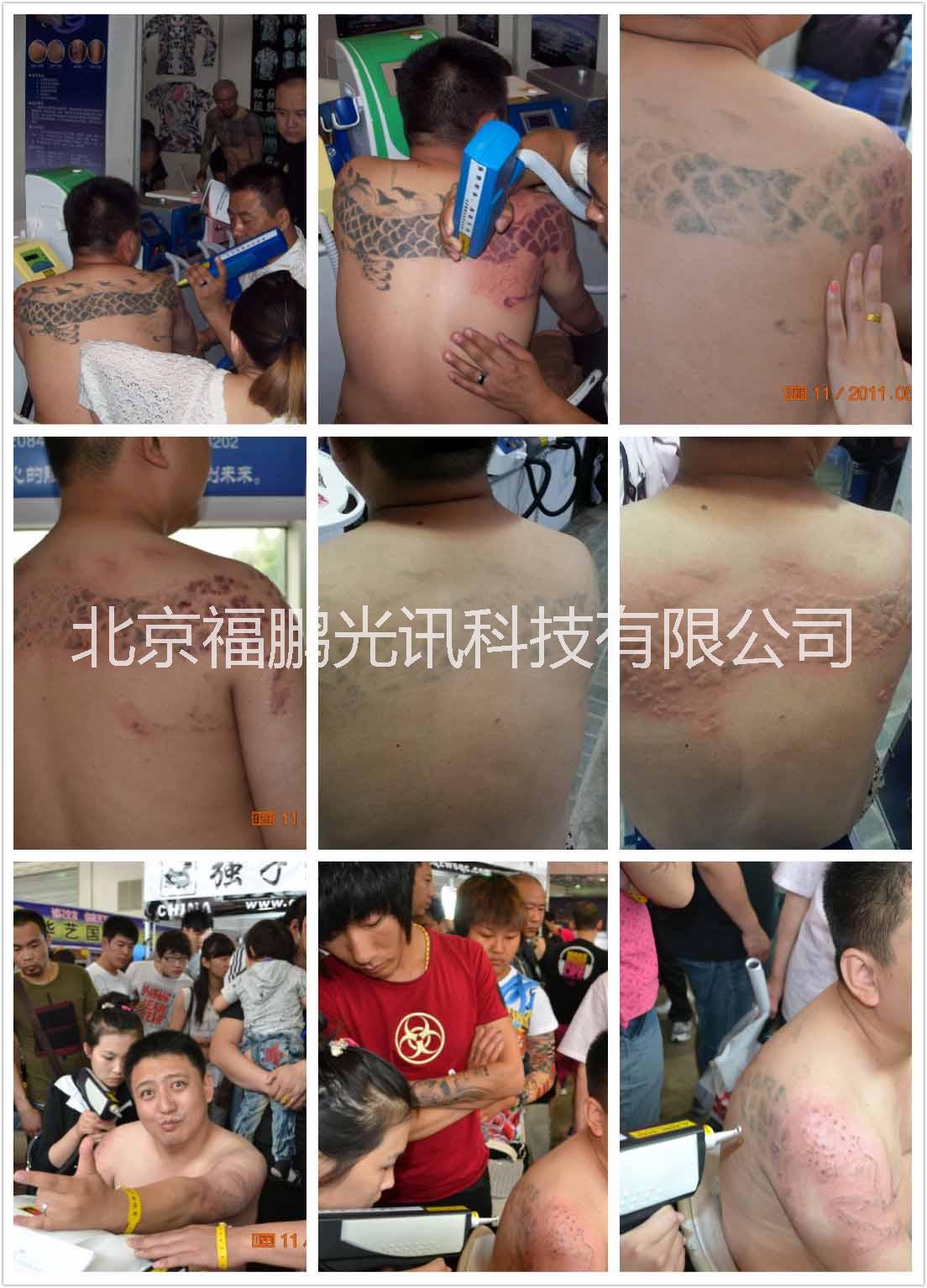 北京市北京至尊K9激光洗纹身机批发厂家供应北京至尊K9激光洗纹身机批发