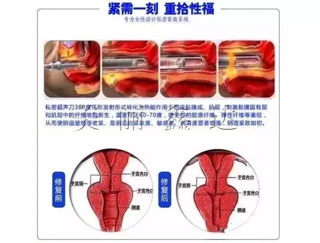 私密超声刀厂家直销图片