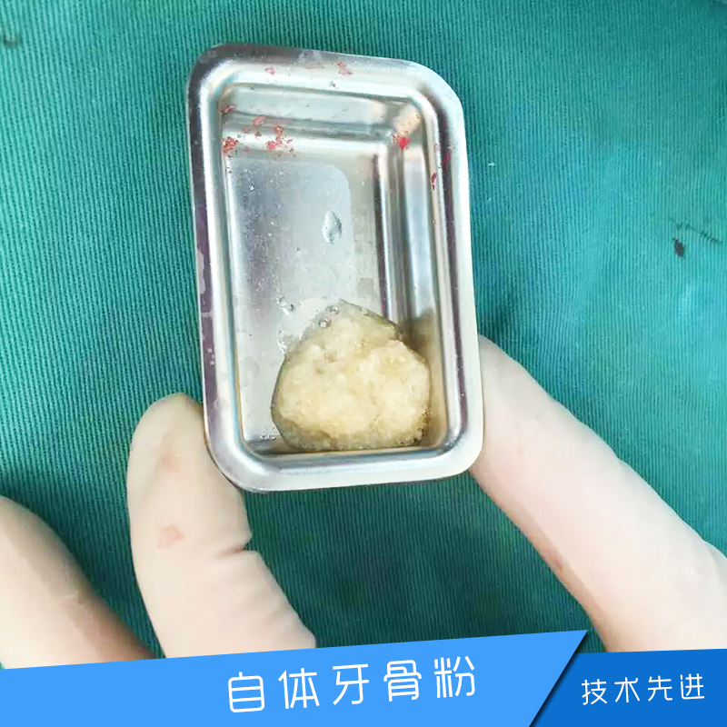 江苏牙科骨粉 口腔种植 自体牙骨粉出售 充填材料