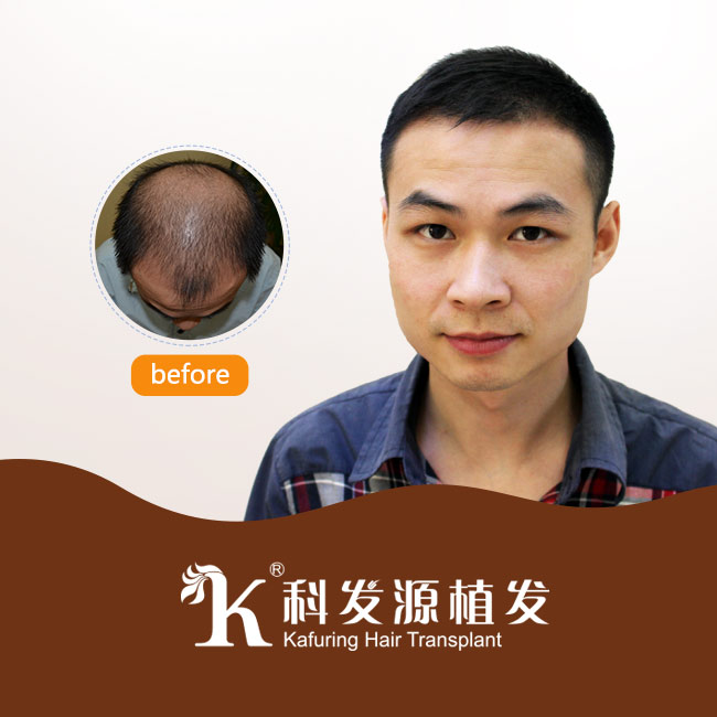 株洲哪里可以植發(fā)圖片