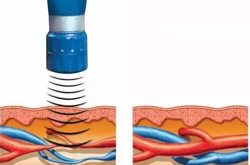 沖擊波疼痛治儀作用原理圖片