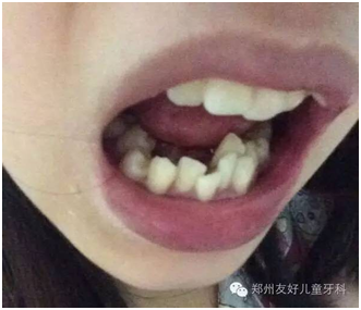 供應(yīng)用于整牙矯正牙齒的牙齒參差排列不齊有哪些危害