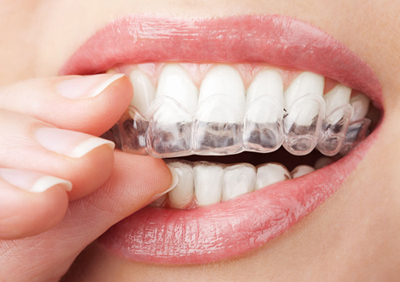 大學(xué)生牙齒矯正、牙齒矯正優(yōu)惠 劉淑英口腔診所