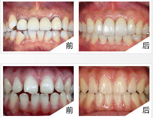 供應(yīng)用于牙齒矯正的鄭州矯正牙齒有哪些方法?