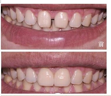 供應(yīng)用于牙齒矯正的鄭州矯正牙齒有哪些方法?