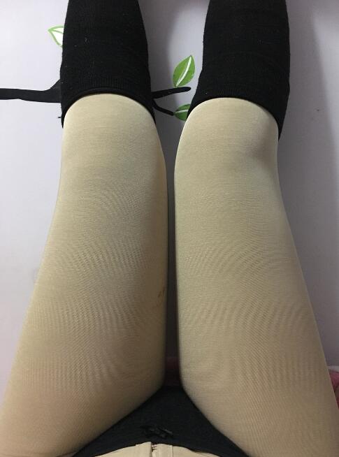 水動(dòng)力*減肥瘦大腿手術(shù)前后對(duì)比