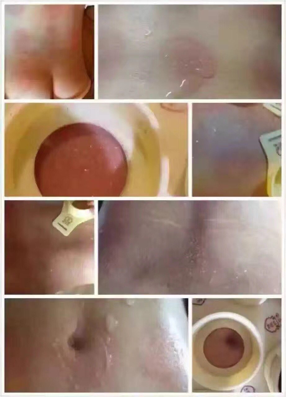 艾灸
