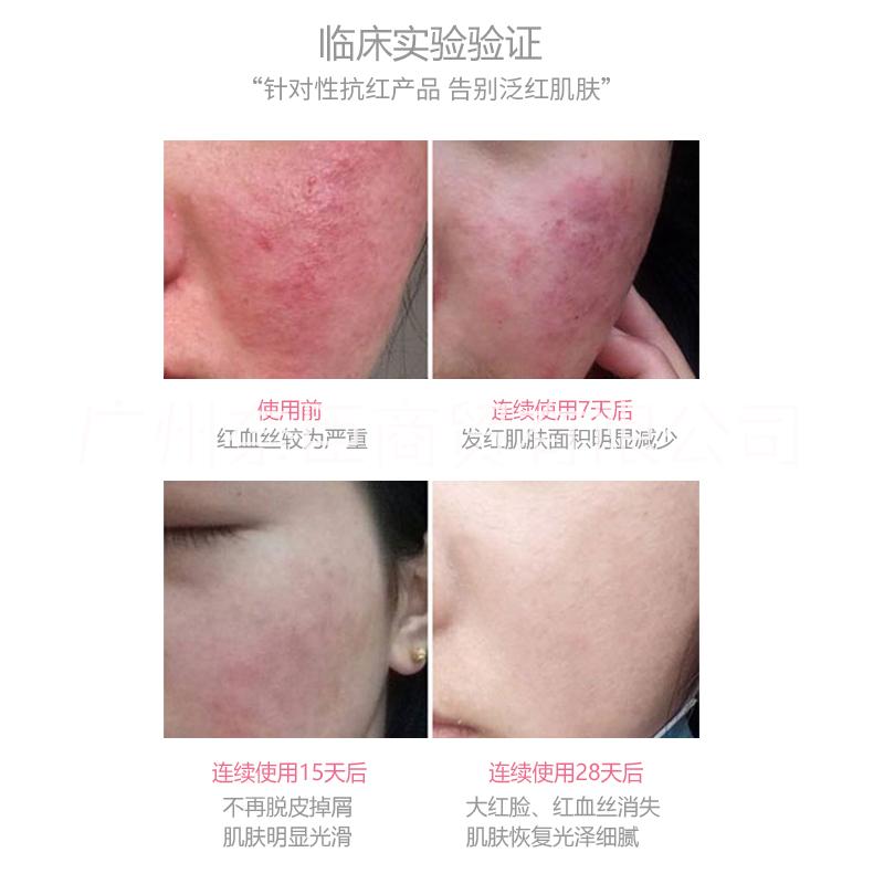 廣東廣州去紅血絲精華OEM代加工_紅血絲修復(fù)精華液oem貼牌_敏感肌修復(fù)精華oem美容院
